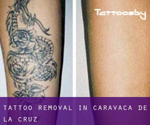 Tattoo Removal in Caravaca de la Cruz