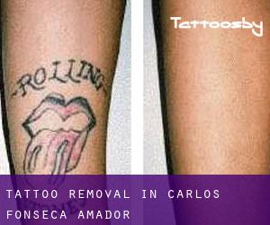 Tattoo Removal in Carlos Fonseca Amador