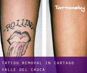 Tattoo Removal in Cartago (Valle del Cauca)