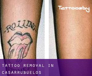 Tattoo Removal in Casarrubuelos