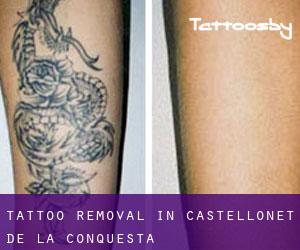 Tattoo Removal in Castellonet de la Conquesta