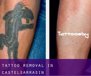 Tattoo Removal in Castelsarrasin