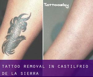 Tattoo Removal in Castilfrío de la Sierra