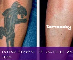 Tattoo Removal in Castille and León