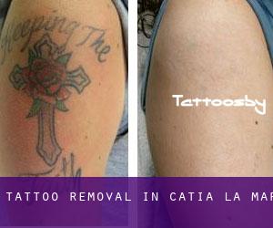 Tattoo Removal in Catia La Mar