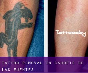 Tattoo Removal in Caudete de las Fuentes
