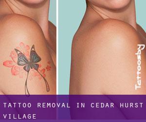 Tattoo Removal in Cedar Hurst Village
