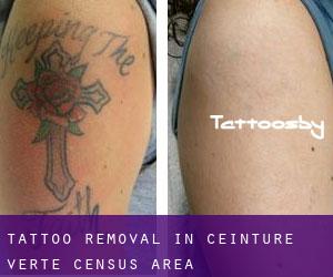 Tattoo Removal in Ceinture-Verte (census area)