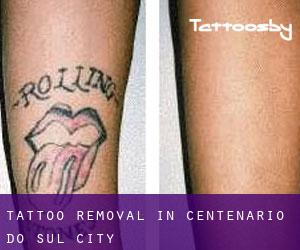 Tattoo Removal in Centenário do Sul (City)