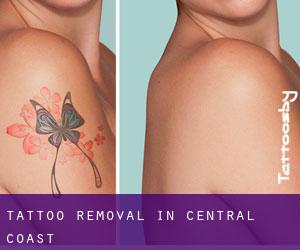 Tattoo Removal in Central Coast