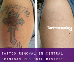 Tattoo Removal in Central Okanagan Regional District