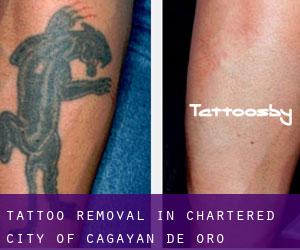 Tattoo Removal in Chartered City of Cagayan de Oro