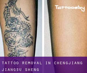 Tattoo Removal in Chengjiang (Jiangsu Sheng)