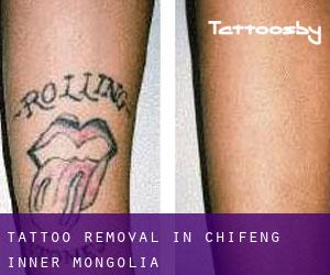 Tattoo Removal in Chifeng (Inner Mongolia)