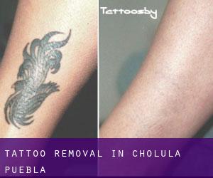 Tattoo Removal in Cholula (Puebla)