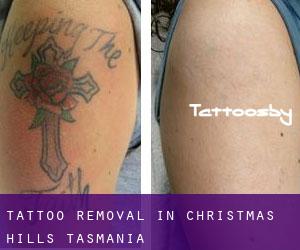 Tattoo Removal in Christmas Hills (Tasmania)