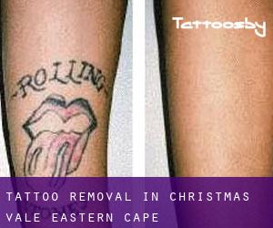 Tattoo Removal in Christmas Vale (Eastern Cape)