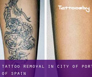 Tattoo Removal in City of Port of Spain