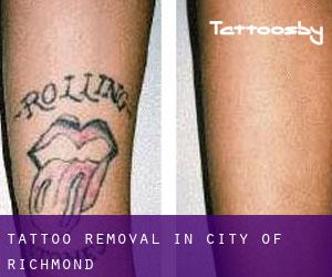 Tattoo Removal in City of Richmond