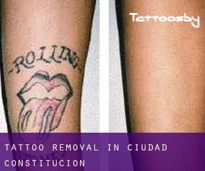 Tattoo Removal in Ciudad Constitución