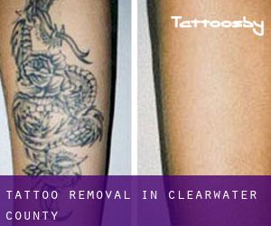 Tattoo Removal in Clearwater County