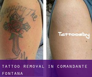 Tattoo Removal in Comandante Fontana