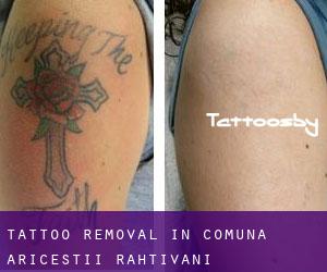 Tattoo Removal in Comuna Ariceştii-Rahtivani