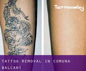Tattoo Removal in Comuna Balcani