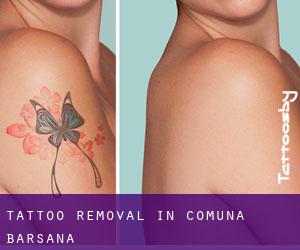 Tattoo Removal in Comuna Bârsana