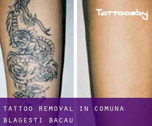 Tattoo Removal in Comuna Blăgeşti (Bacău)