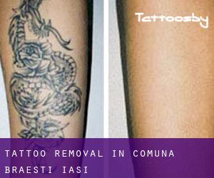 Tattoo Removal in Comuna Brăeşti (Iaşi)