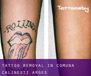Tattoo Removal in Comuna Călineşti (Argeş)