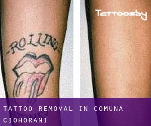 Tattoo Removal in Comuna Ciohorãni