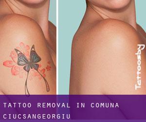 Tattoo Removal in Comuna Ciucsângeorgiu