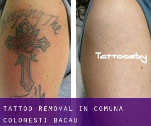 Tattoo Removal in Comuna Coloneşti (Bacău)