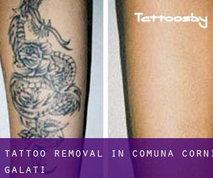 Tattoo Removal in Comuna Corni (Galaţi)