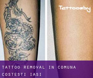 Tattoo Removal in Comuna Costeşti (Iaşi)