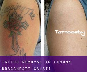 Tattoo Removal in Comuna Drăgăneşti (Galaţi)