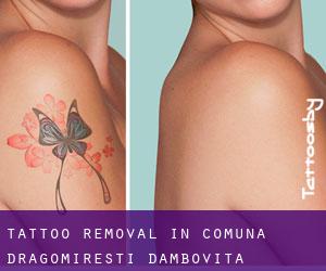 Tattoo Removal in Comuna Dragomireşti (Dâmboviţa)