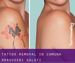 Tattoo Removal in Comuna Drăguşeni (Galaţi)