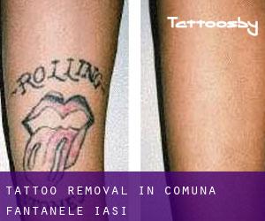 Tattoo Removal in Comuna Fântânele (Iaşi)
