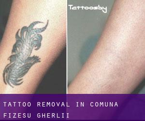 Tattoo Removal in Comuna Fizeşu Gherlii