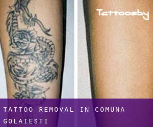 Tattoo Removal in Comuna Golãieşti