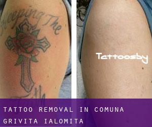 Tattoo Removal in Comuna Griviţa (Ialomiţa)