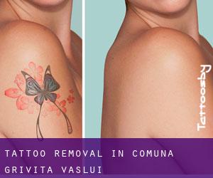 Tattoo Removal in Comuna Griviţa (Vaslui)