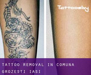 Tattoo Removal in Comuna Grozeşti (Iaşi)