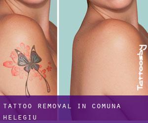 Tattoo Removal in Comuna Helegiu