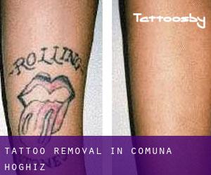 Tattoo Removal in Comuna Hoghiz