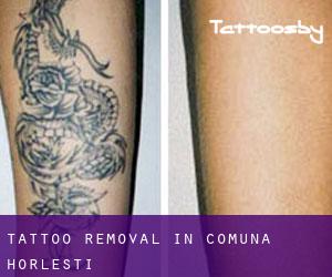 Tattoo Removal in Comuna Horleşti