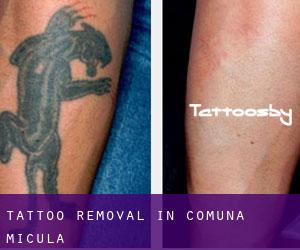 Tattoo Removal in Comuna Micula